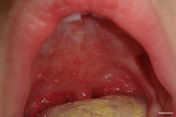A szájban lévő hólyagok fájdalmasak is lehetnek
